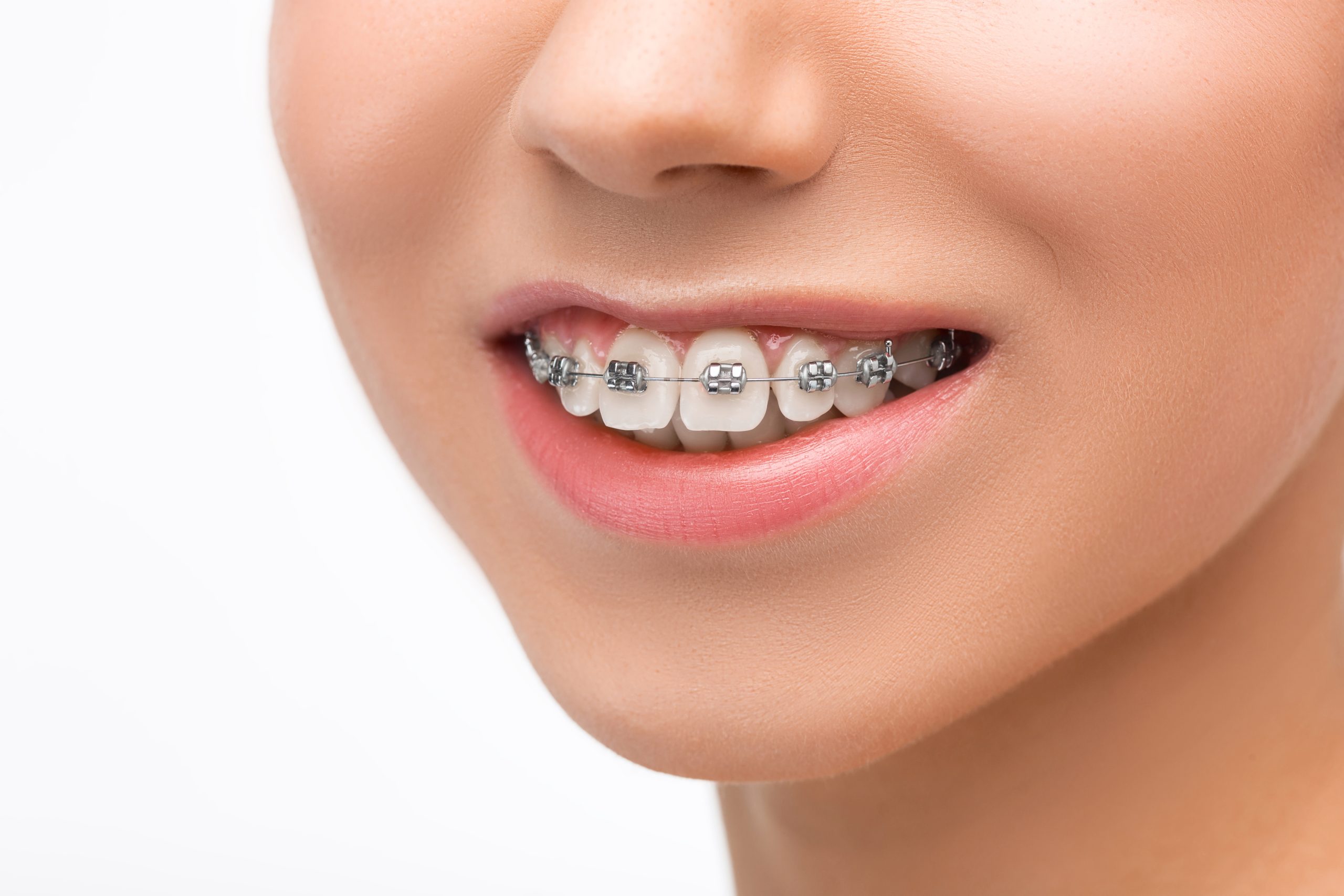 Invisible Aligners for Teeth: